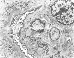 type I membranoproliferative glomerulonephritis type I membranoproliferative glomerulonephritis